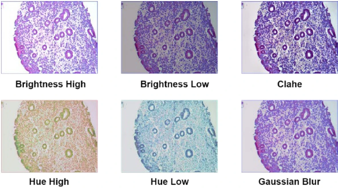 AI diagnoses major cancer with near perfect accuracy | Charles Darwin University